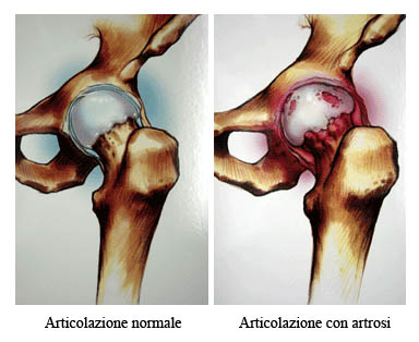 semne de artrită și cum să tratezi
